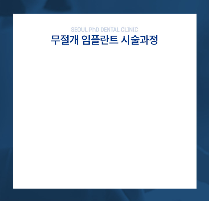 컴퓨터 분석을 이용한 임플란트 시술과정